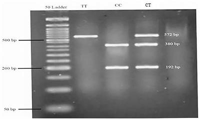 The Interaction Between Fatty Acid Desaturase-2 (FADS2) rs174583 Genetic Variant and Dietary Quality Indices (DASH and MDS) Constructs Different Metabolic Phenotypes Among Obese Individuals